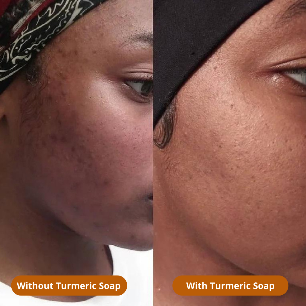 LEMON TURMERIC & KOJIC ACID SOAP