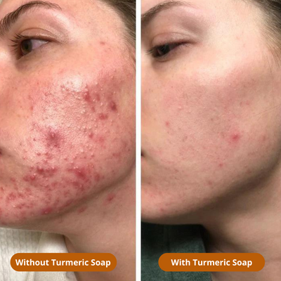 SET TURMERIC- MANOUGLOW